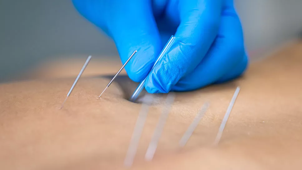 Hand in blue glove inserting dry needles into skin during a dry needling therapy session for pain relief and muscle relaxation.